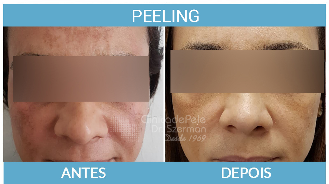 Resultados Reais: Peeling de Diamante Antes e Depois em Diferentes Tipos de Pele