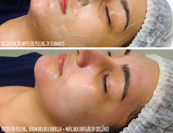 Quantas Sessões de Peeling de Diamante Você Precisa para uma Pele Perfeita?