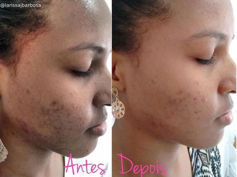 Resultados Reais: Peeling de Diamante Antes e Depois em Diferentes Tipos de Pele