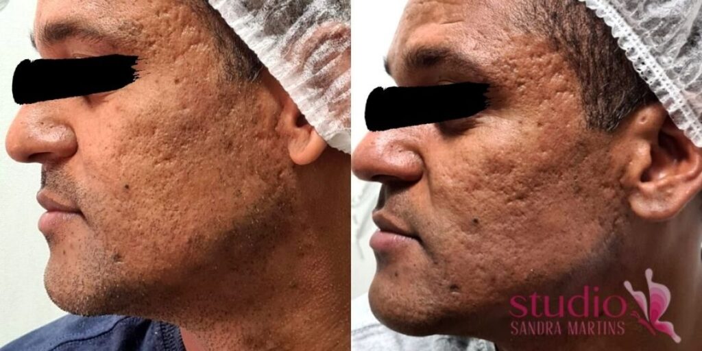 Mitos e Verdades sobre o Peeling de Diamante: O Que Você Precisa Saber