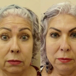 Quantas Sessões de Peeling de Diamante Você Precisa para uma Pele Perfeita?