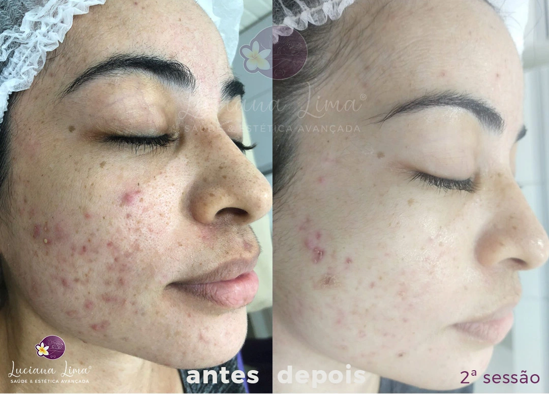 Comparativo: Peeling de Diamante vs. Peeling Químico – Qual o Melhor para Sua Pele?