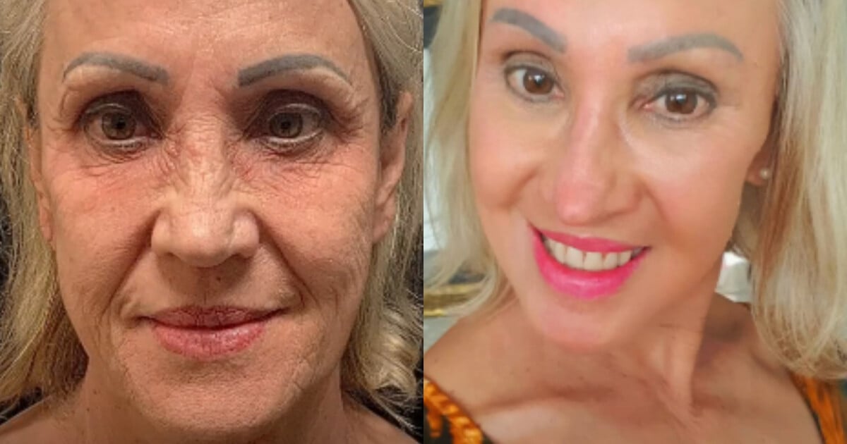 Melasma: Desvendando Tratamentos e Resultados Reais