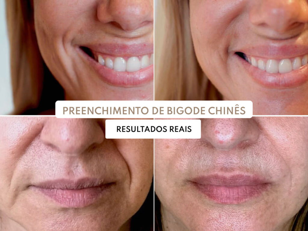 Melasma: Desvendando Tratamentos e Resultados Reais