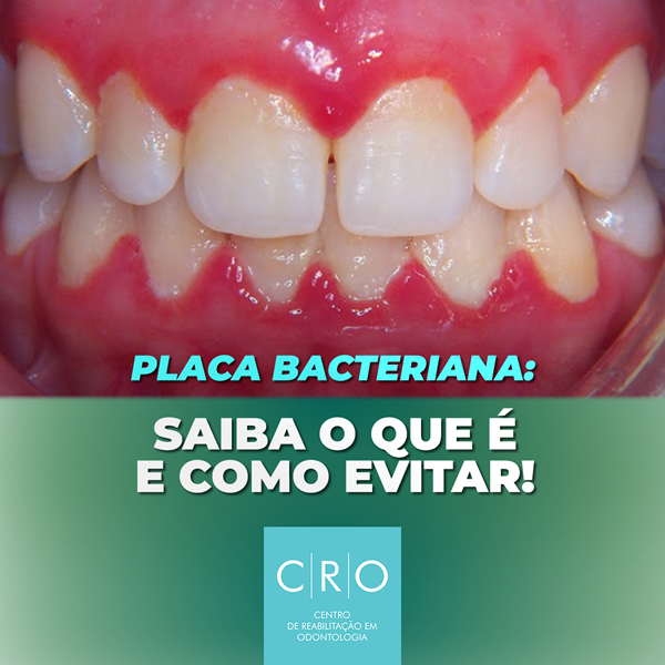 Placa Bacteriana