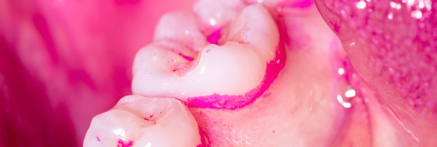 Gengivite e Periodontite: Entenda as Doenças Causadas pela Placa