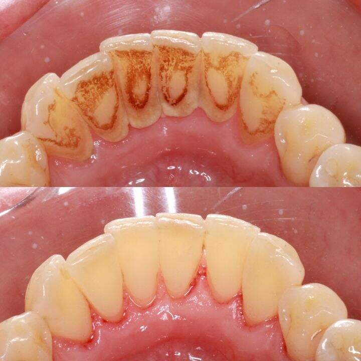 Gengivite e Periodontite: Entenda as Doenças Causadas pela Placa