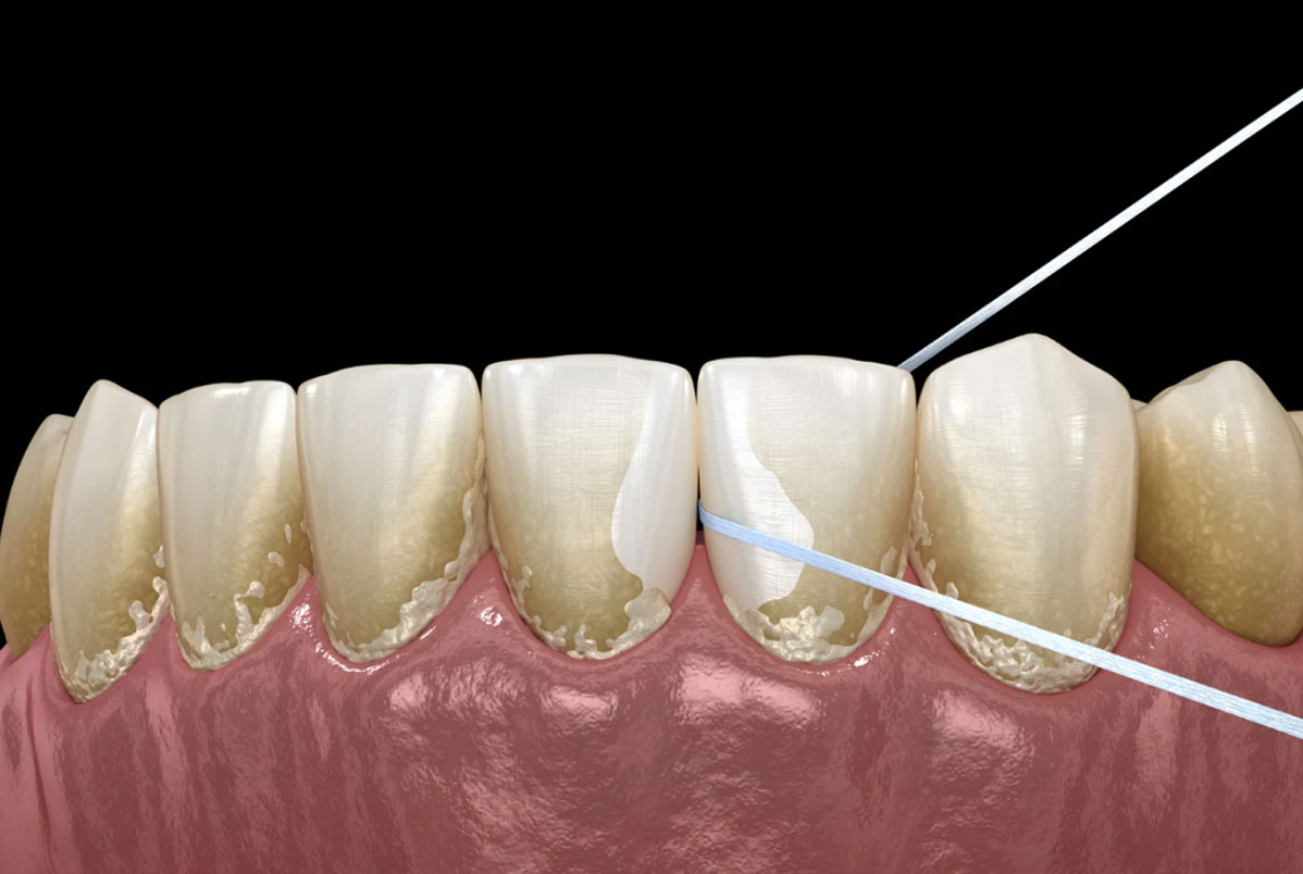 Quando Visitar o Dentista: A Importância da Limpeza Profissional