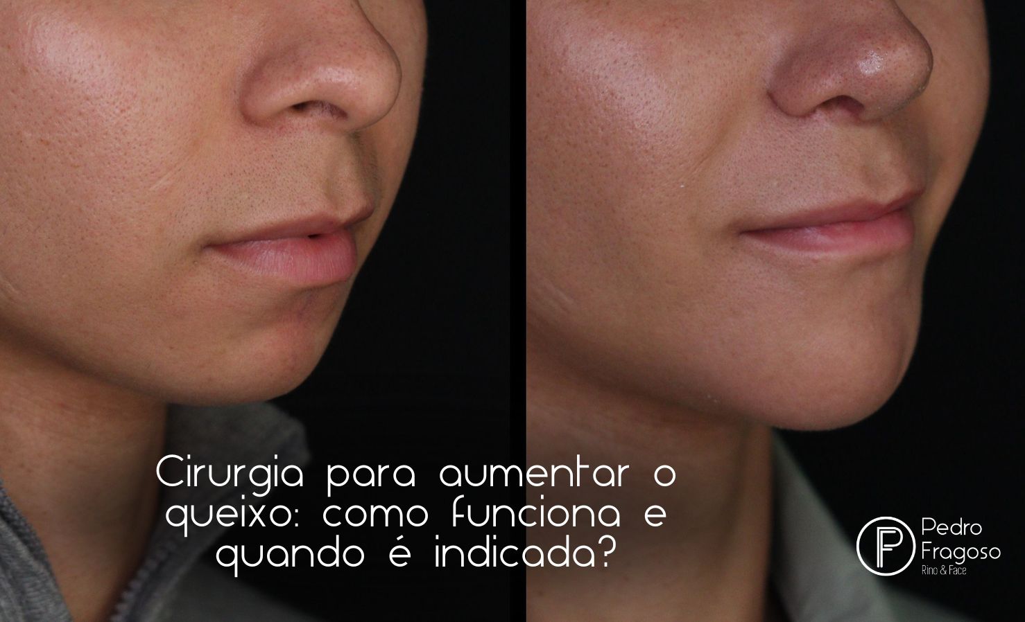 1. Mentoplastia: O Guia Completo para Aumento e Redução do Queixo
2. Tipos de Mentoplastia: Cirúrgica vs. Não Cirúrgica
3. Recuperação e Cuidados Pós-Operatórios da Mentoplastia
4. Mentoplastia: Entenda os Custos e o Que Esperar
5. Como a Mentoplastia Pode Melhorar a Harmonia Facial