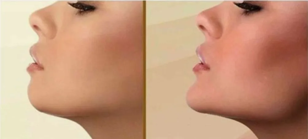 1. Mentoplastia: O Guia Completo para Aumento e Redução do Queixo
2. Tipos de Mentoplastia: Cirúrgica vs. Não Cirúrgica
3. Recuperação e Cuidados Pós-Operatórios da Mentoplastia
4. Mentoplastia: Entenda os Custos e o Que Esperar
5. Como a Mentoplastia Pode Melhorar a Harmonia Facial