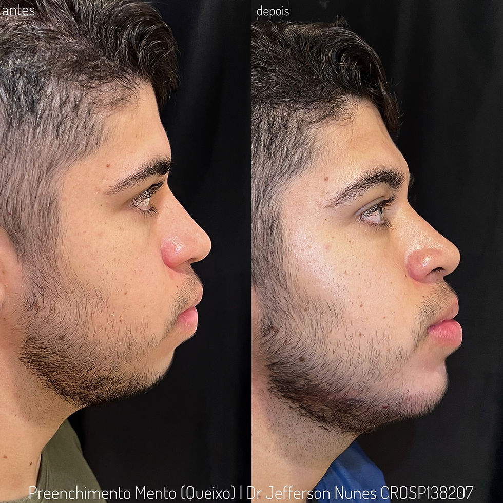 1. Mentoplastia: O Guia Completo para Aumento e Redução do Queixo
2. Tipos de Mentoplastia: Cirúrgica vs. Não Cirúrgica
3. Recuperação e Cuidados Pós-Operatórios da Mentoplastia
4. Mentoplastia: Entenda os Custos e o Que Esperar
5. Como a Mentoplastia Pode Melhorar a Harmonia Facial