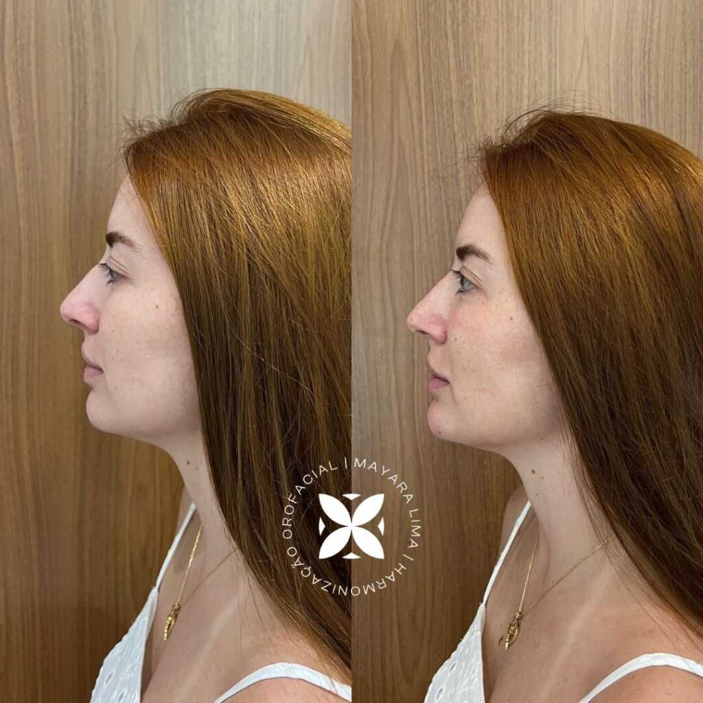 1. Mentoplastia: O Guia Completo para Aumento e Redução do Queixo
2. Tipos de Mentoplastia: Cirúrgica vs. Não Cirúrgica
3. Recuperação e Cuidados Pós-Operatórios da Mentoplastia
4. Mentoplastia: Entenda os Custos e o Que Esperar
5. Como a Mentoplastia Pode Melhorar a Harmonia Facial