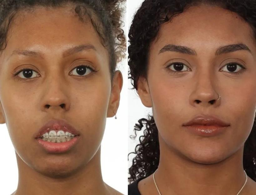 1. Mentoplastia: O Guia Completo para Aumento e Redução do Queixo
2. Tipos de Mentoplastia: Cirúrgica vs. Não Cirúrgica
3. Recuperação e Cuidados Pós-Operatórios da Mentoplastia
4. Mentoplastia: Entenda os Custos e o Que Esperar
5. Como a Mentoplastia Pode Melhorar a Harmonia Facial