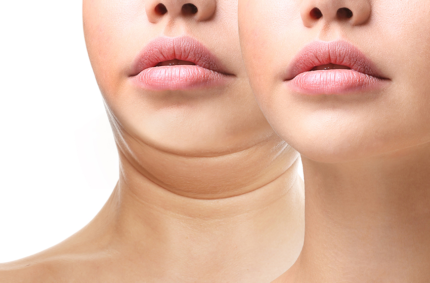 1. Mentoplastia: O Guia Completo para Aumento e Redução do Queixo
2. Tipos de Mentoplastia: Cirúrgica vs. Não Cirúrgica
3. Recuperação e Cuidados Pós-Operatórios da Mentoplastia
4. Mentoplastia: Entenda os Custos e o Que Esperar
5. Como a Mentoplastia Pode Melhorar a Harmonia Facial