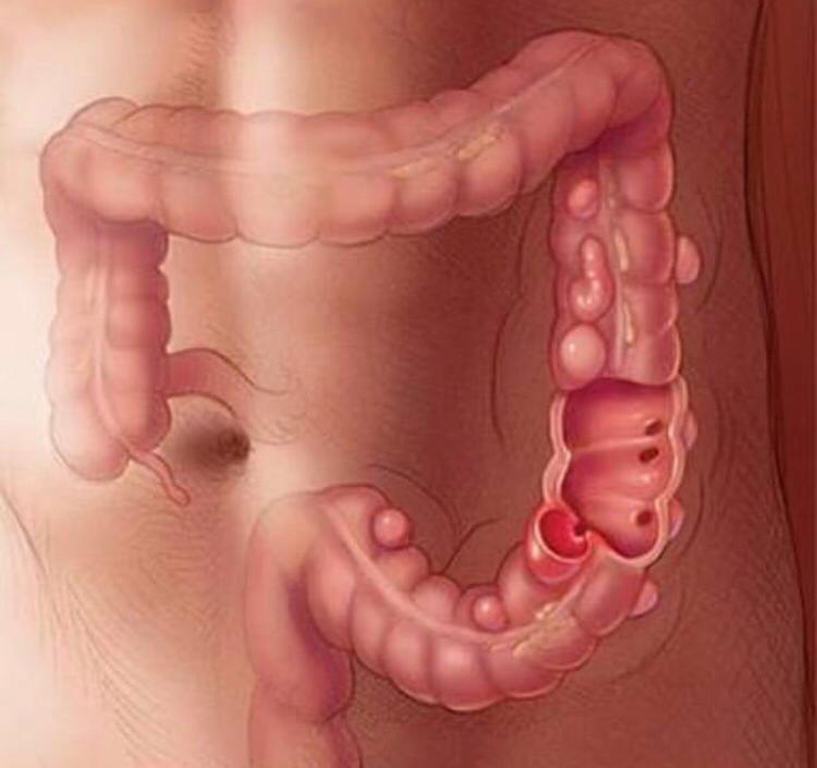 antibiótico para diverticulite preço