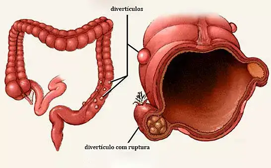 tratamento para diverticulite leve