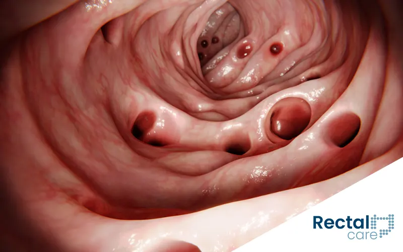 remédio para dor de diverticulite