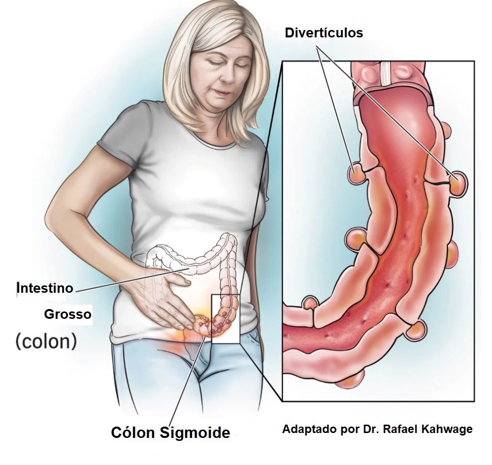 diverticulite tratamento hospitalar