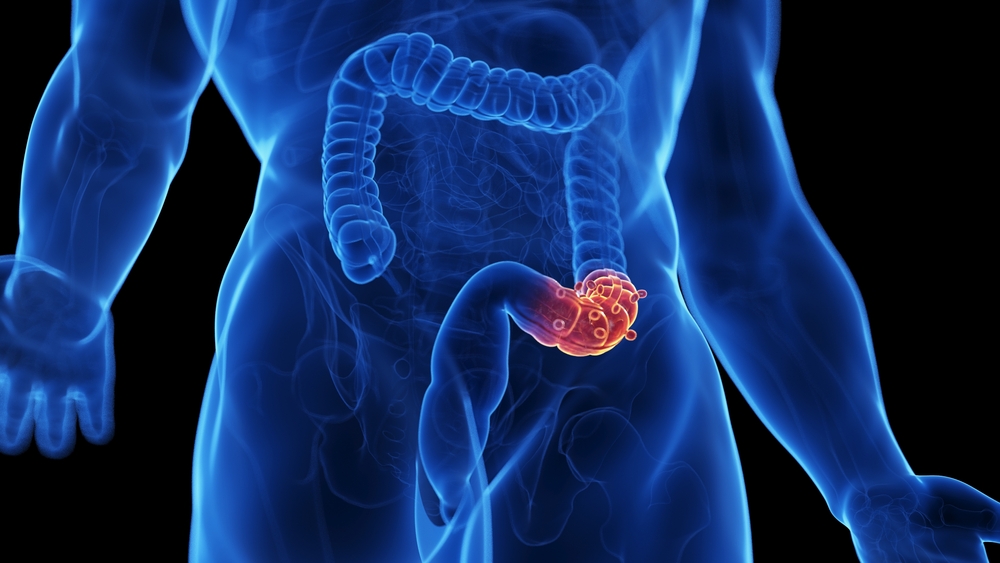 como aliviar cólica de diverticulite