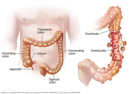 diverticulite tratamento hospitalar
