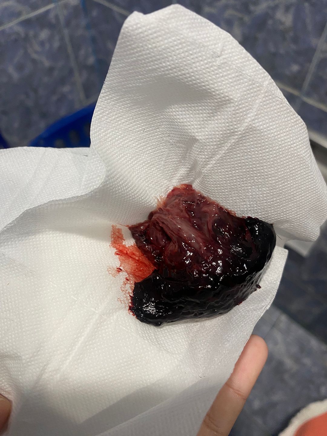 Sangramento Depois Do Parto