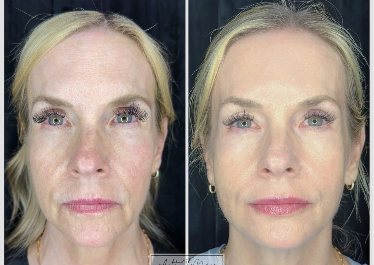 melhores resultados sculptra antes e depois