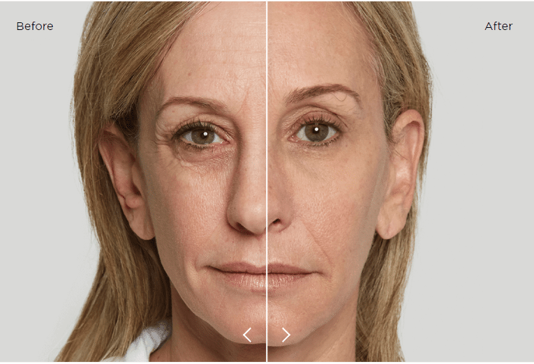 sculptra preço por sessão vale a pena