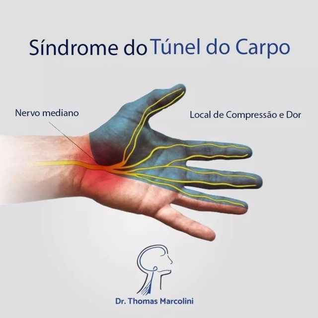 Sindrome Do Tunel Do Carpo