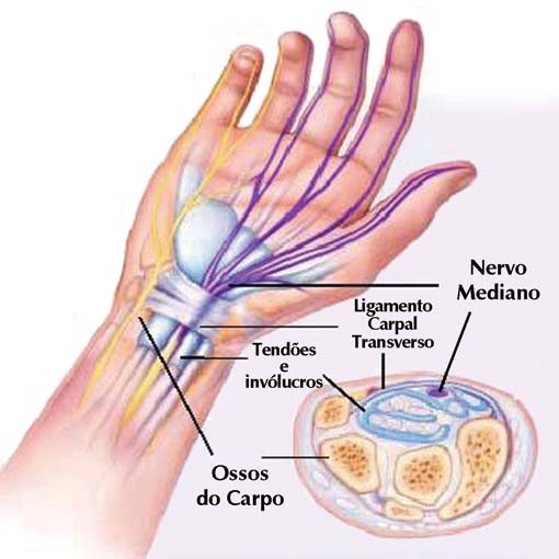 Exercícios e Fisioterapia para Aliviar a Síndrome do Túnel do Carpo
