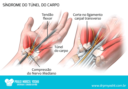 Quando a Cirurgia é Necessária para a Síndrome do Túnel do Carpo?