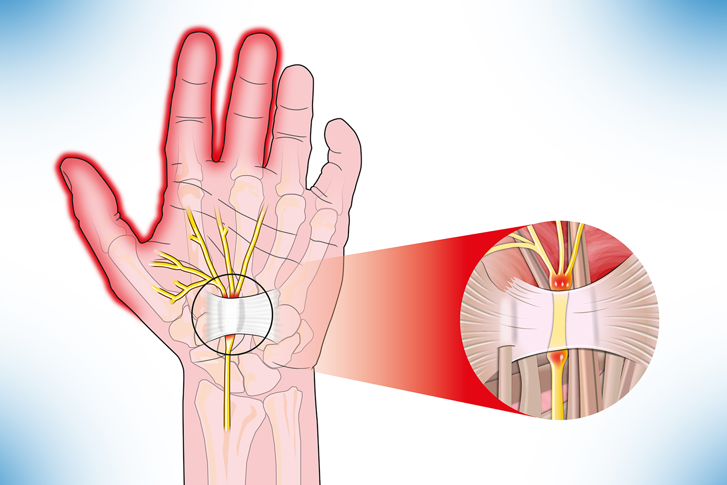Diferença entre Síndrome do Túnel do Carpo e Outras Dores no Pulso