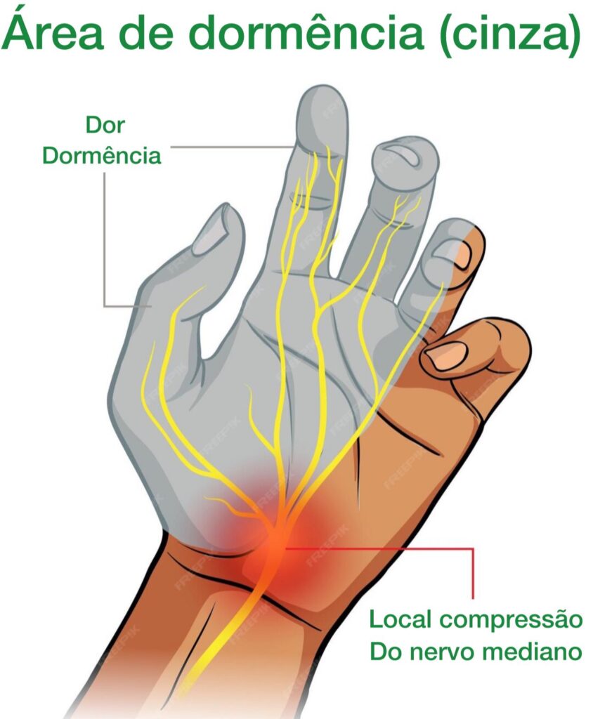 Sindrome Do Tunel Do Carpo