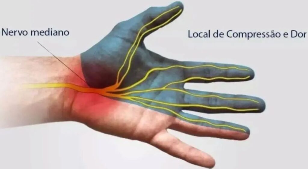 Síndrome do Túnel do Carpo na Gravidez: O Que Saber e Como Aliviar