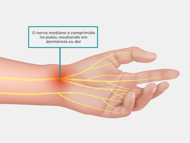 Exercícios e Fisioterapia para Aliviar a Síndrome do Túnel do Carpo