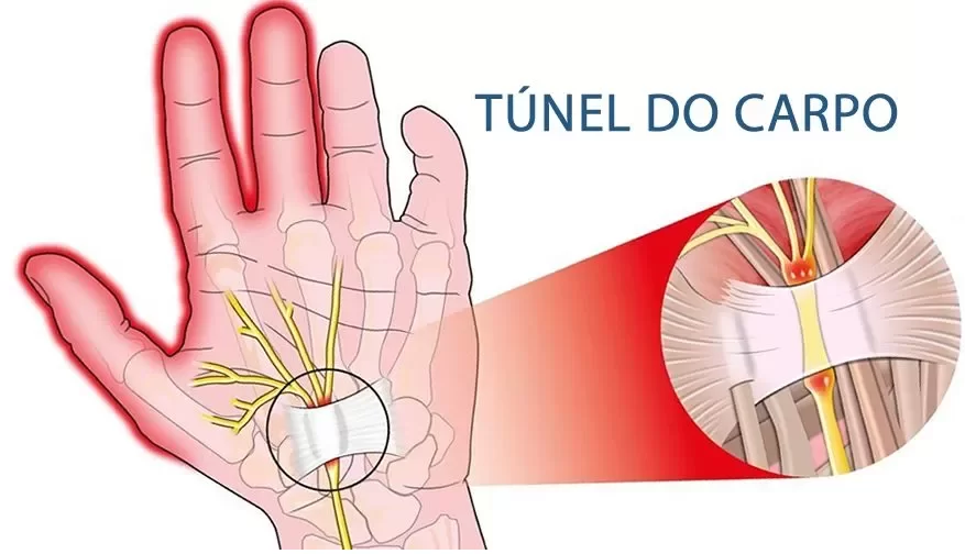 Quando a Cirurgia é Necessária para a Síndrome do Túnel do Carpo?