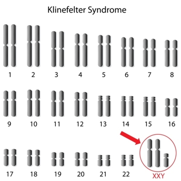 Infertilidade Masculina e Síndrome de Klinefelter: Opções de Reprodução Assistida
