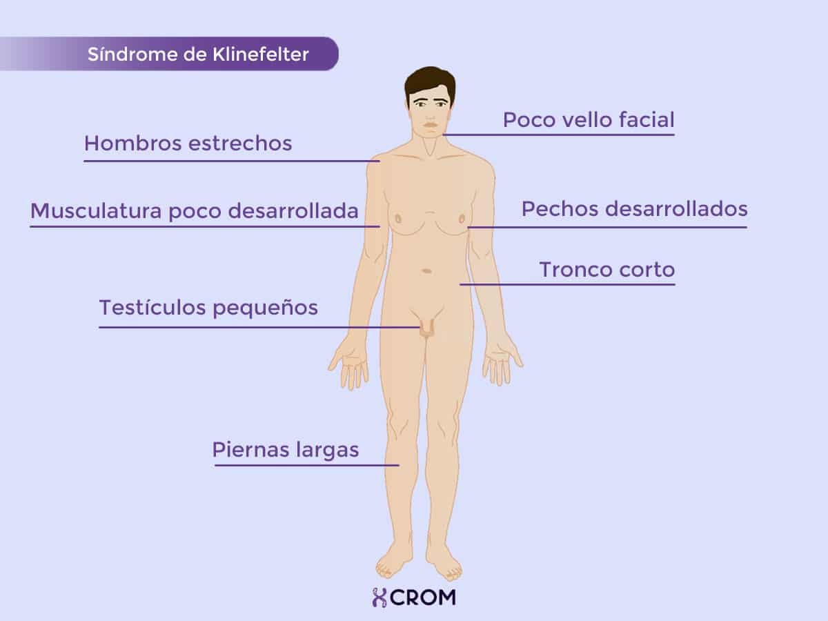 Síndrome de Klinefelter em Crianças: Sinais Precoces e Intervenção