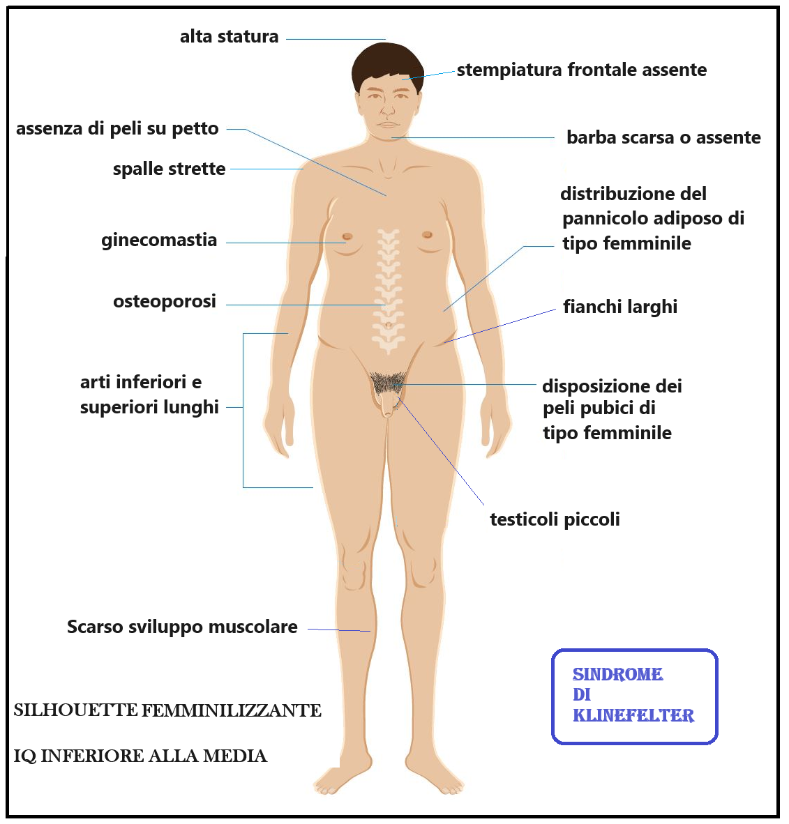 Sindrome Klinefelter