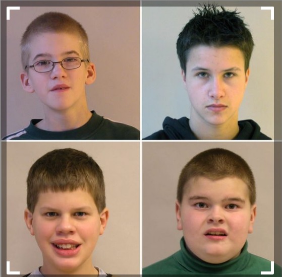 XXY: Entenda o Diagnóstico da Síndrome de Klinefelter