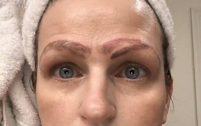 Doenças da Tireoide e Queda de Sobrancelhas: O Que Você Precisa Saber