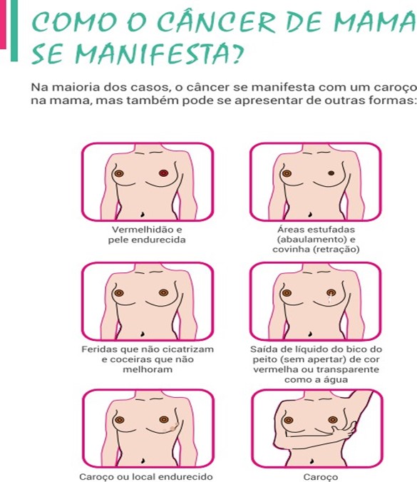 5 ideias de títulos:
1. Câncer de Mama: Entenda as Taxas de Sobrevivência por Estágio e o Impacto do Diagnóstico Precoce.
2. Fatores Cruciais que Influenciam a Sobrevivência do Câncer de Mama: Do Subtipo Biológico ao Acesso ao Tratamento.
3. A Revolução nos Tratamentos do Câncer de Mama: Novas Terapias e o Aumento da Sobrevida Global.
4. Câncer de Mama Metastático: O Que as Novas Pesquisas Dizem Sobre a Sobrevivência e Qualidade de Vida.
5. Desvendando o Prognóstico do Câncer de Mama: Como o Estágio e Outros Fatores Afetam a Expectativa de Vida.