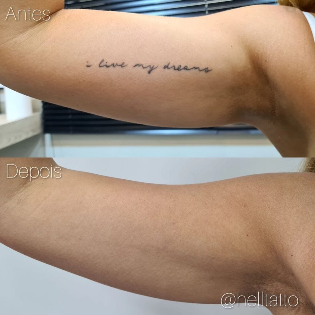 proteger tatuagem braço sol