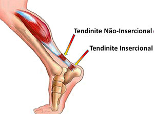Protocolo de Alfredson: Guia Completo de Exercícios para Tendinite de Aquiles