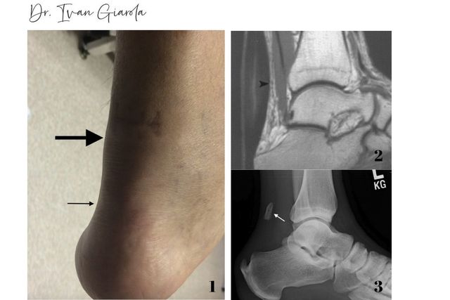 Palmilhas para Tendinite de Aquiles: Quando Usar e Qual Escolher