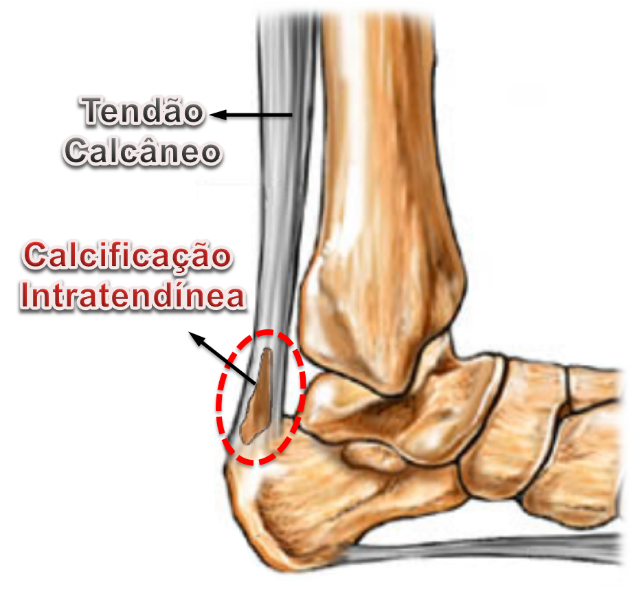 Prevenção da Tendinite Calcânea: Dicas para Atletas e Sedentários