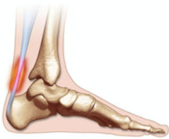 Doença de Haglund: Entenda a Relação com a Tendinite Insercional do Calcâneo