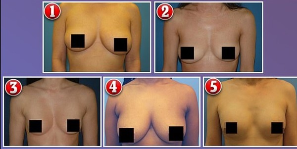 Mitos e verdades sobre os diferentes tipos de seios