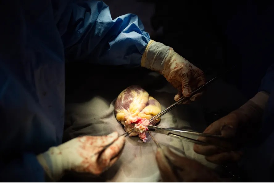 taxa de sucesso transplante cardíaco