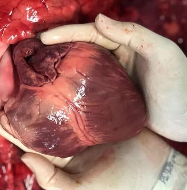 recuperação após transplante de coração