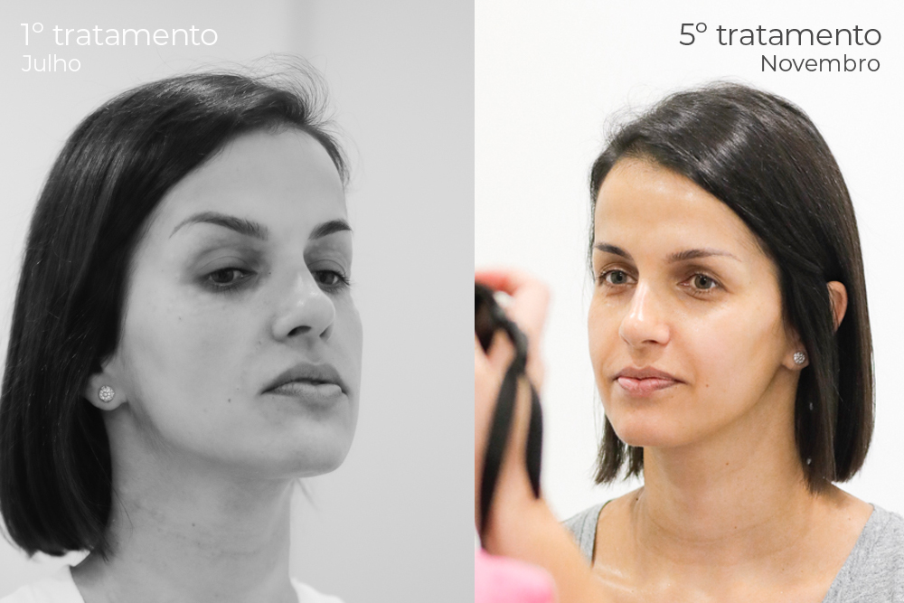 Guia Completo: Como Identificar o Tipo de Olheira e Escolher o Tratamento Certo